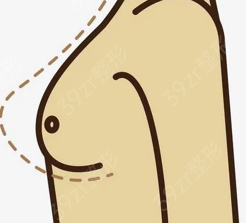 脂肪填充胸部多少钱？了解脂肪填充胸部的费用