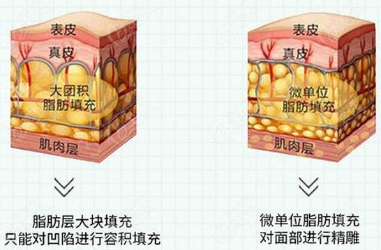 脂肪填充需要多少钱？了解脂肪填充的价格