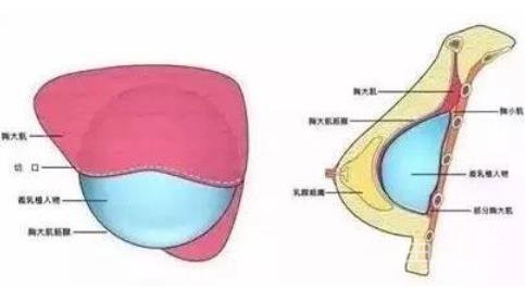 科普|假体丰胸手术的原理以整形方法优缺点
