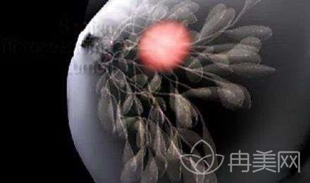 为什么你做假体隆胸会出现失败？当失败了我们怎么办?