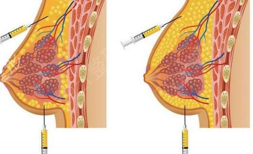 上海自体脂肪丰胸多少钱?自体脂肪隆胸果怎么样?